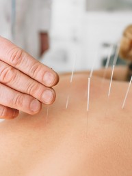 Acupuncturist inserting a needle into a female back